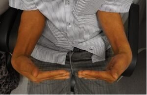 Surgery returned good function to engineer at 6 weeks after injury.