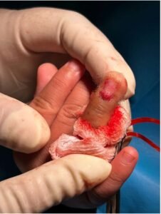 A child’s curious hand, used as an exploratory tool, is often at risk of injury.