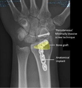 Knowledge of specialised techniques and implants improves outcomes. These implants do not require a second surgery for removal.