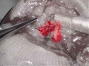 “Super-microsurgery” allows us to repair the smallest vessels - the artery in this picture is 0.3 mm diameter.