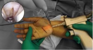 Figure 1: In the minimally invasive endoscopic technique, a special blade is introduced through a small incision in the wrist to safely cut the tight ligament (in circle; white)