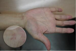 Two weeks after surgery, the wound is healed and the scar will gradually fade. Symptoms from nerve compression are fully resolved.